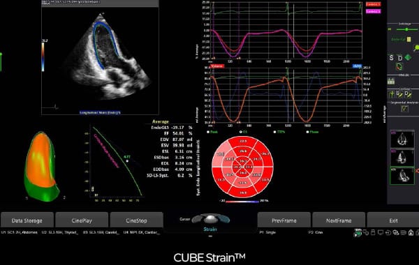 Ekran analizy odkształceń serca CUBE Strain na aparacie USG Alpinion XCUBE i8.